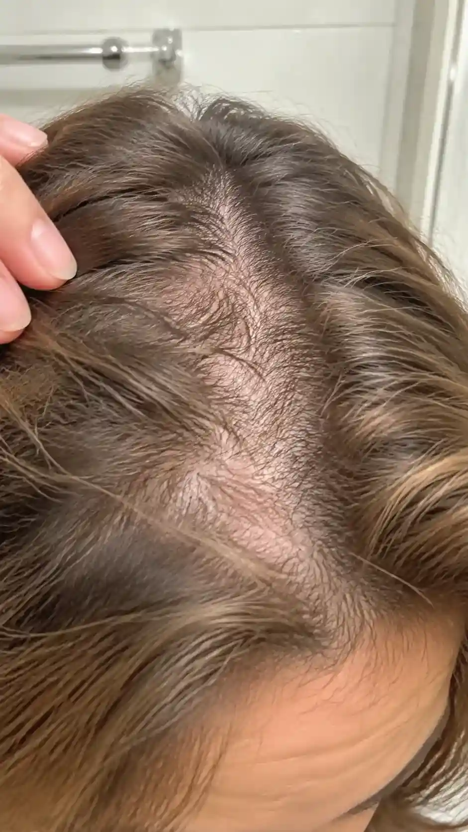 Nahaufnahme von dünnem Haar mit sichtbarem Ansatz - extrem dünne haare frisur